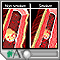 Tobacco use - effects on arteries