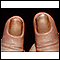 Síndrome das unhas amarelas