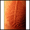 Dermografismo - imagem detalhada