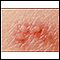 Herpes-zóster (Cobreiro) - imagem aproximada da lesão
