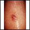 Ceratoacantoma