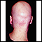 Alopecia totalis - visão da parte de trás da cabeça