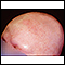 Alopecia totalis - visão da parte frontal da cabeça