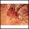 Câncer de pele, carcinoma basocelular - pigmentado
