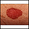 Câncer de pele, carcinoma basocelular - disseminação