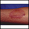 Dermatite de contato