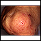 Dermatite herpetiforme no joelho