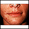 Dermatite perioral