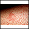 Eczema, atópico - imagem em close