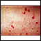 Eritema multiforme nas pernas