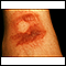 Fixed drug eruption, bullous