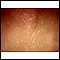 Tinea versicolor - aproximação