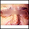 Vitiligo no rosto