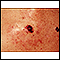 Câncer de pele, imagem em close de melanoma nível IV