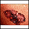 Câncer de pele, melanoma extensivo superficial