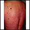 Sarcoma de Kaposi nas costas