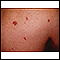 Sarcoma de Kaposi - imagem detalhada