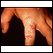 Tinha, tinea manuum no dedo