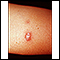 Sarcoidose - imagem detalhada