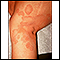 Tinha, tinea corporis na perna