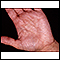 Hiperlinearidade em dermatite atópica