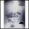 Obstrução do intestino delgado - raio X