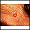 Carcinoma basocelular - face