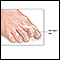 Hammer toe (deformação do dedo do pé)