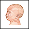 Choro excessivo, 0-6 meses