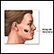 Melanoma maligno